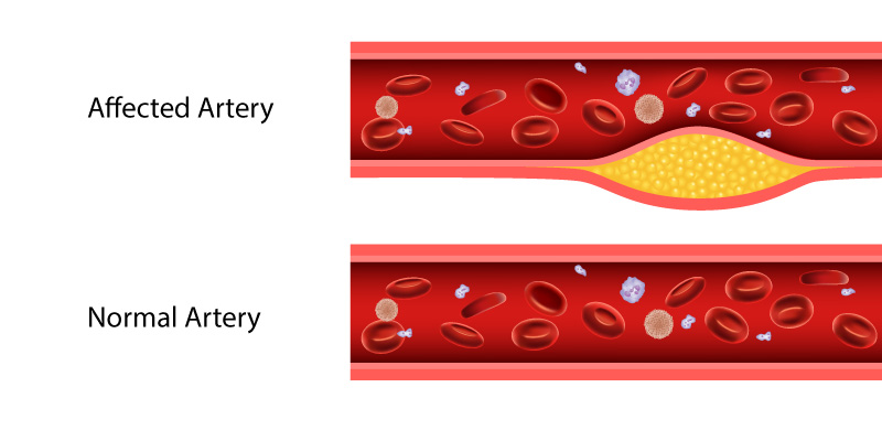 Cause-of-Aortic-Aneurysm