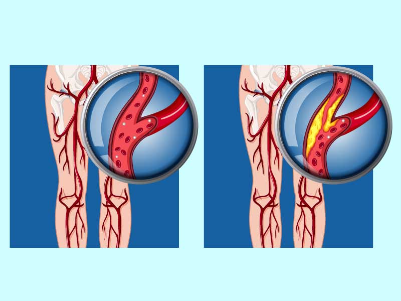 Cause-of-Peripheral-Arterial-Disease