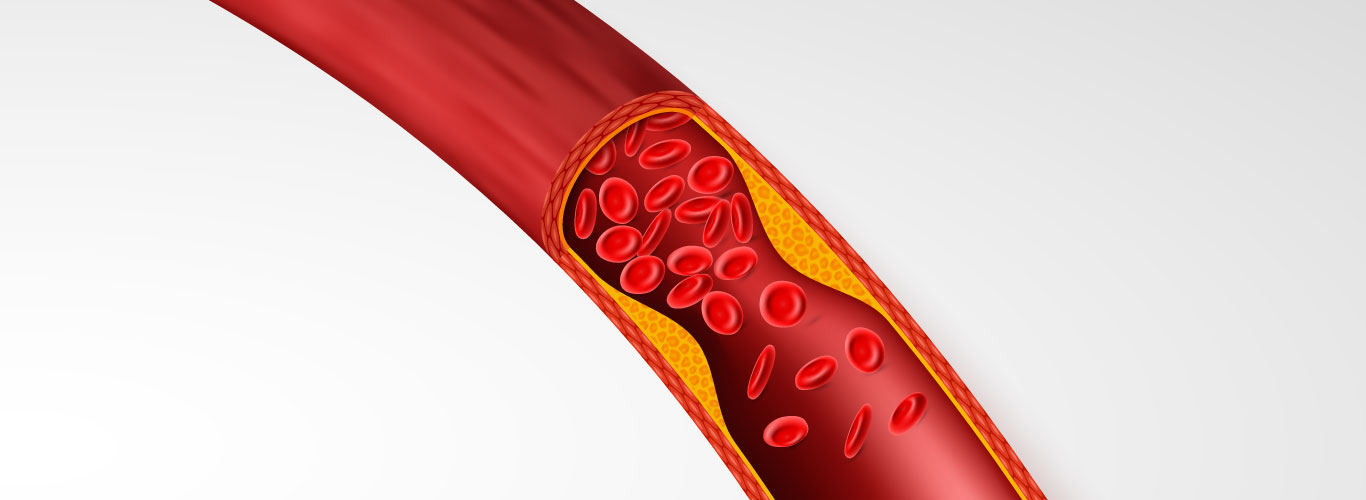Coronary-Artery-Disease-Symptoms-Causes-Diagnosis