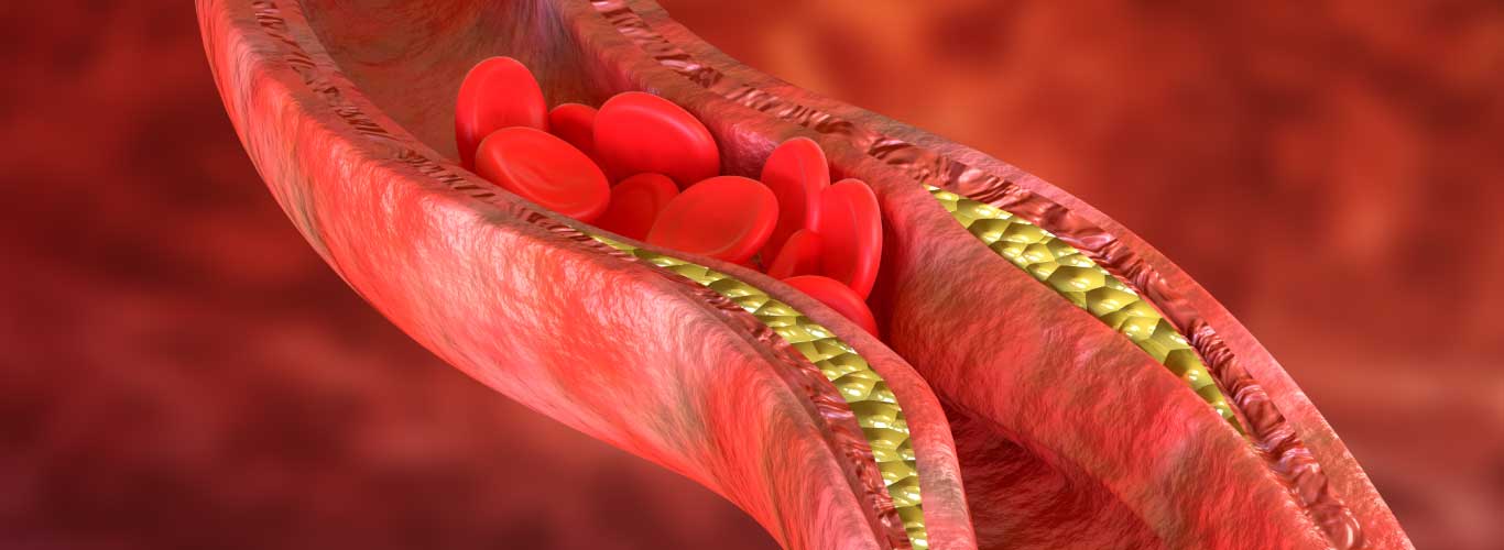 Peripheral-Arterial-Disease-Symptoms-Causes-Diagnosis