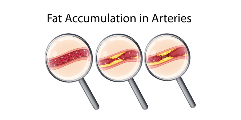 causes-of-Acute-Coronary-Syndrome